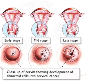 Cervical-Cancer Stages